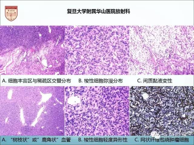 【病例】三脑室孤立性纤维瘤/血管外皮瘤1例MR影像表现