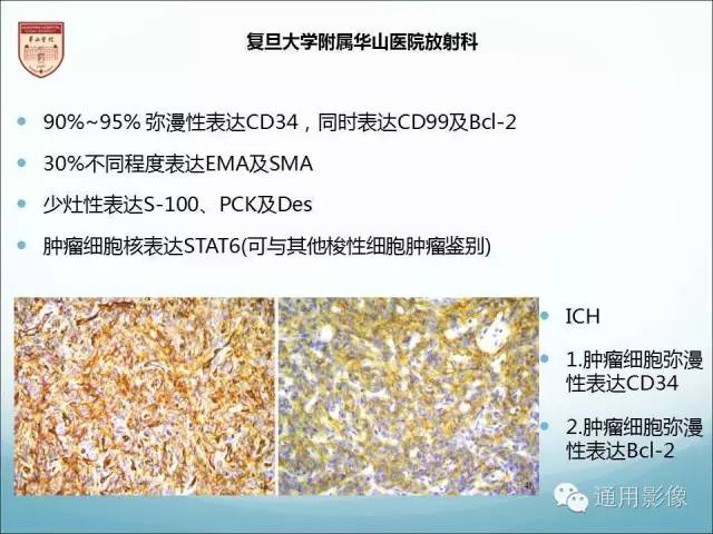 【病例】三脑室孤立性纤维瘤/血管外皮瘤1例MR影像表现