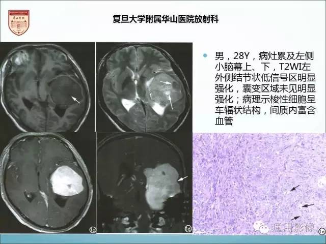 【病例】三脑室孤立性纤维瘤/血管外皮瘤1例MR影像表现