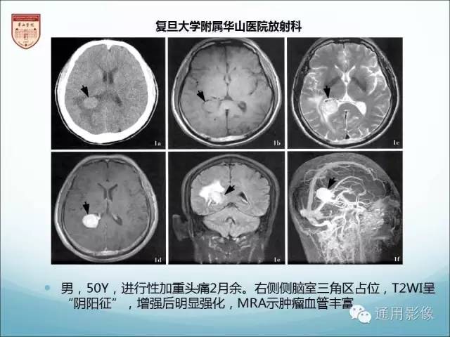 【病例】三脑室孤立性纤维瘤/血管外皮瘤1例MR影像表现