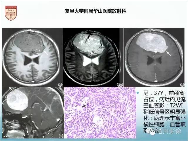 【病例】三脑室孤立性纤维瘤/血管外皮瘤1例MR影像表现