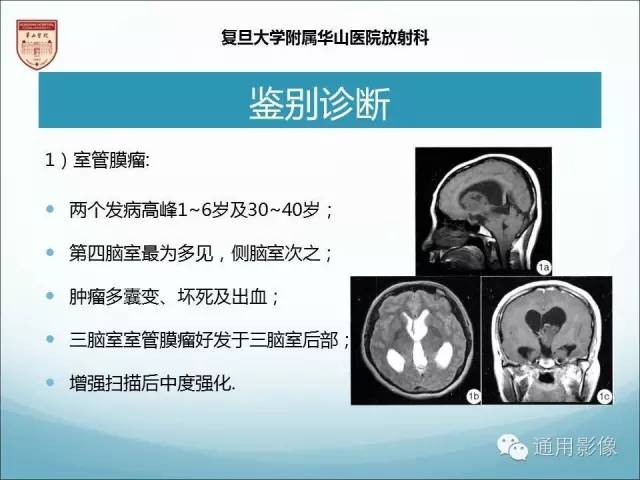【病例】三脑室孤立性纤维瘤/血管外皮瘤1例MR影像表现