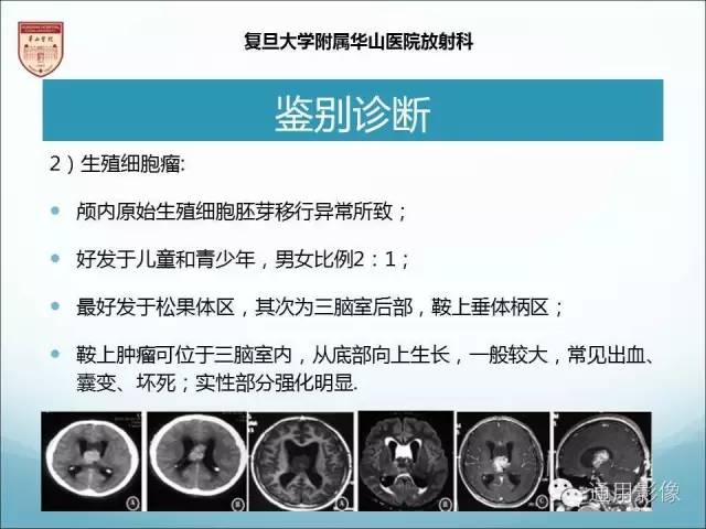 【病例】三脑室孤立性纤维瘤/血管外皮瘤1例MR影像表现