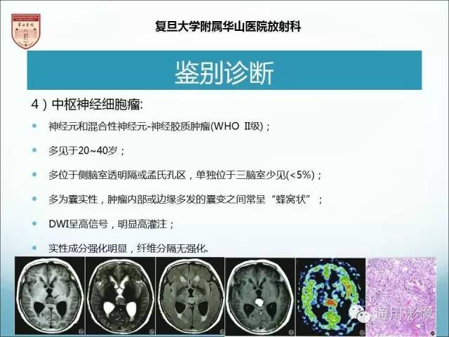 【病例】三脑室孤立性纤维瘤/血管外皮瘤1例MR影像表现