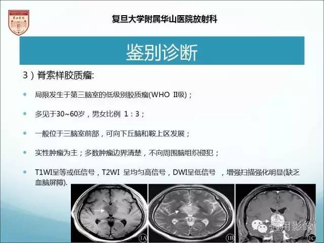 【病例】三脑室孤立性纤维瘤/血管外皮瘤1例MR影像表现