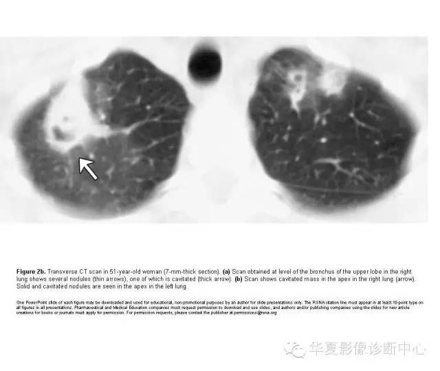 肺隐球菌病的CT诊断 肺隐球菌病的CT诊断