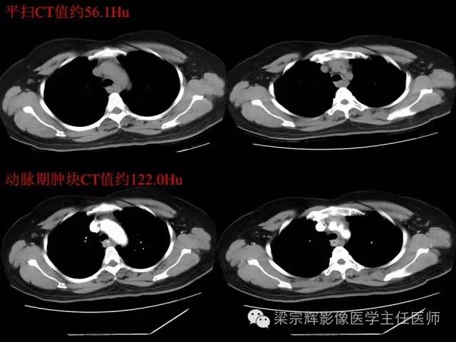 【病例】后纵隔血管球瘤1例CT影像表现