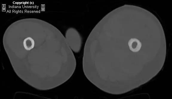 【病例】股骨原发骨淋巴瘤1例影像表现 【病例】股骨原发骨淋巴瘤1例影像表现