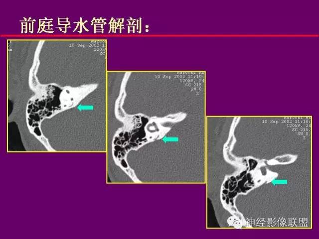【PPT】颅底重要CT解剖及其临床意义