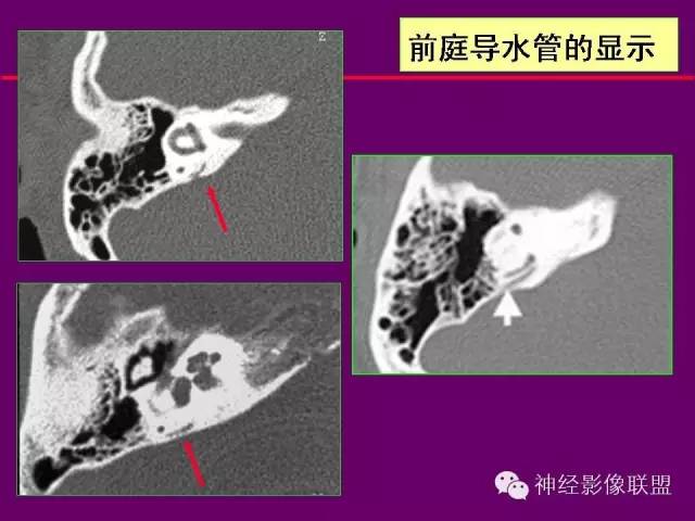 【PPT】颅底重要CT解剖及其临床意义