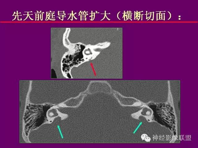 【PPT】颅底重要CT解剖及其临床意义