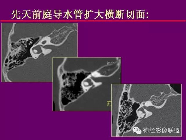 【PPT】颅底重要CT解剖及其临床意义