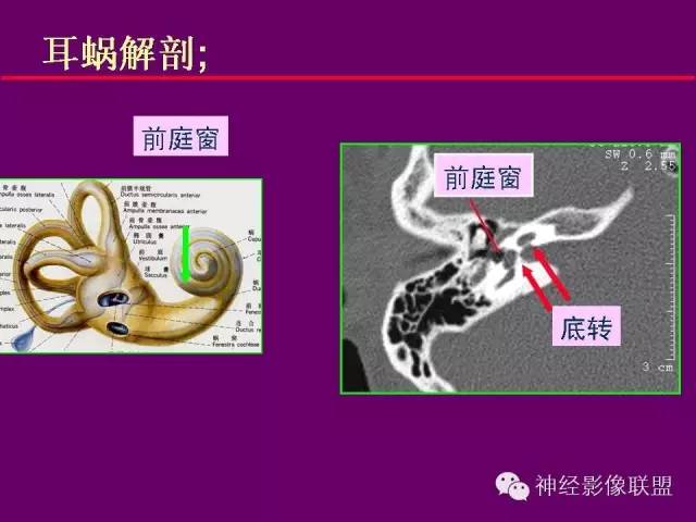 【PPT】颅底重要CT解剖及其临床意义