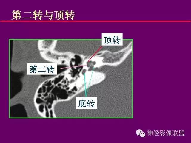 【PPT】颅底重要CT解剖及其临床意义