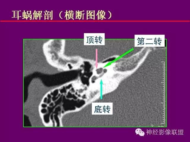 【PPT】颅底重要CT解剖及其临床意义