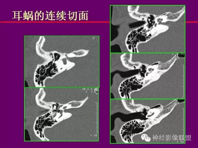 【PPT】颅底重要CT解剖及其临床意义