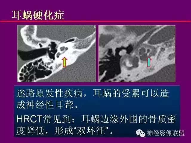 【PPT】颅底重要CT解剖及其临床意义