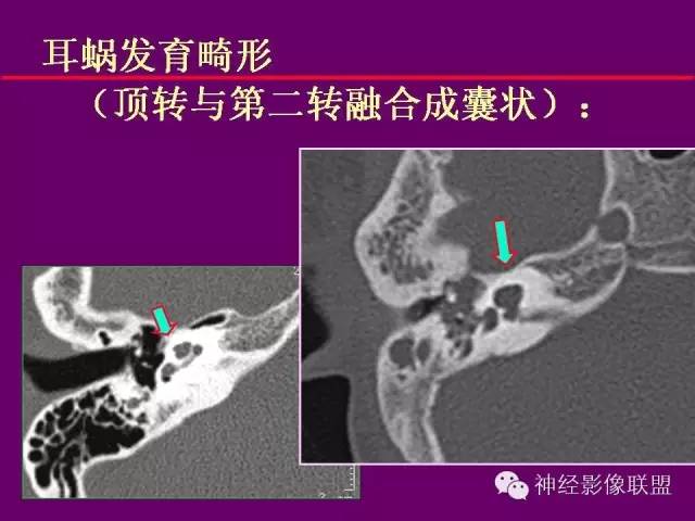 【PPT】颅底重要CT解剖及其临床意义