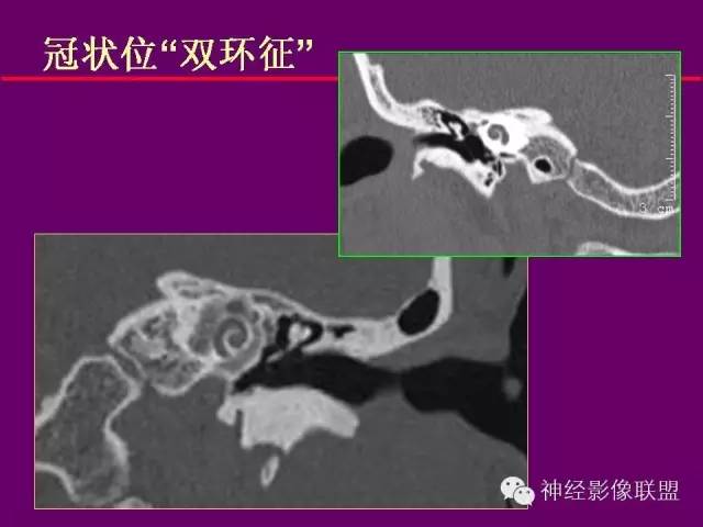 【PPT】颅底重要CT解剖及其临床意义
