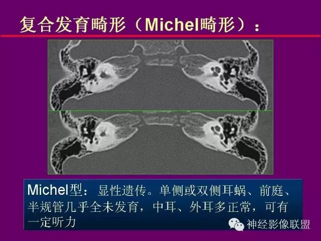 【PPT】颅底重要CT解剖及其临床意义