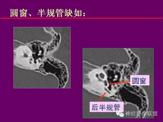 【PPT】颅底重要CT解剖及其临床意义
