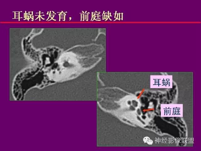 【PPT】颅底重要CT解剖及其临床意义