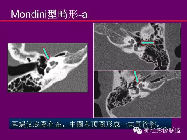 【PPT】颅底重要CT解剖及其临床意义
