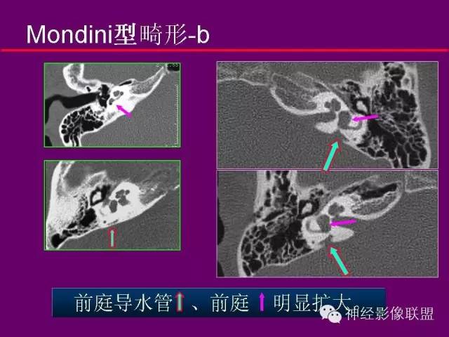 【PPT】颅底重要CT解剖及其临床意义