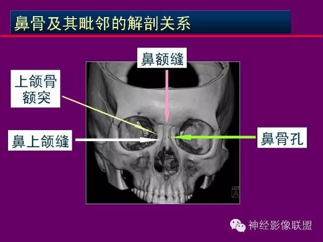 【PPT】颅底重要CT解剖及其临床意义