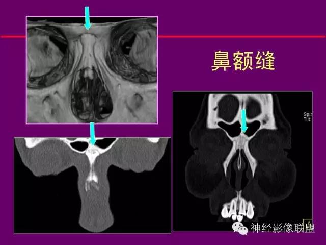【PPT】颅底重要CT解剖及其临床意义