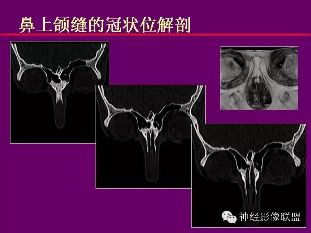 【PPT】颅底重要CT解剖及其临床意义