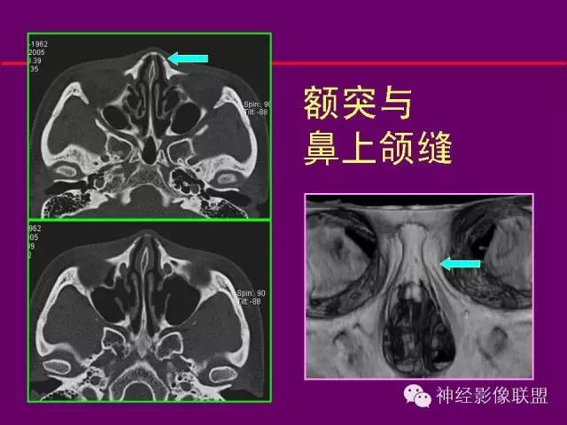 【PPT】颅底重要CT解剖及其临床意义