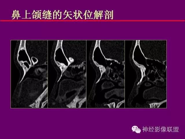 【PPT】颅底重要CT解剖及其临床意义