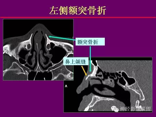 【PPT】颅底重要CT解剖及其临床意义