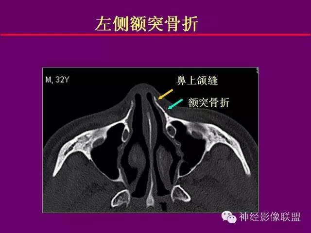 【PPT】颅底重要CT解剖及其临床意义