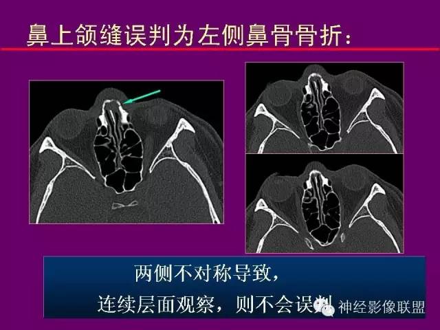 【PPT】颅底重要CT解剖及其临床意义