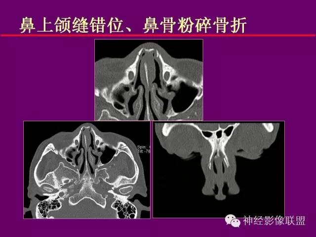 【PPT】颅底重要CT解剖及其临床意义