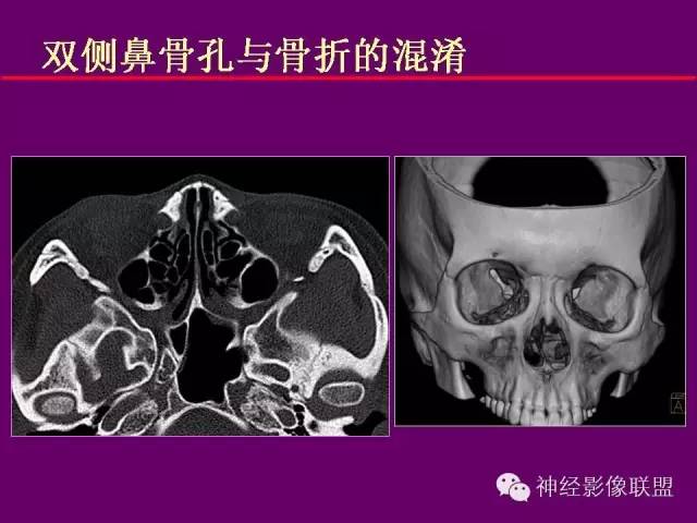 【PPT】颅底重要CT解剖及其临床意义