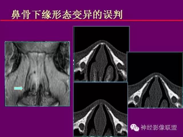 【PPT】颅底重要CT解剖及其临床意义