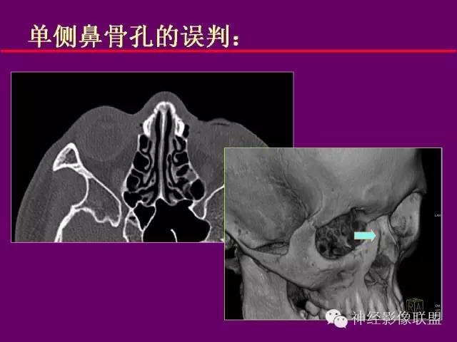 【PPT】颅底重要CT解剖及其临床意义