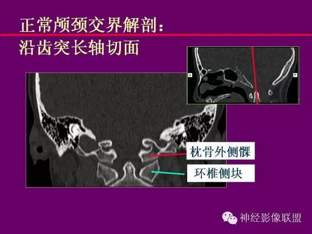 【PPT】颅底重要CT解剖及其临床意义