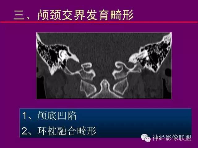 【PPT】颅底重要CT解剖及其临床意义