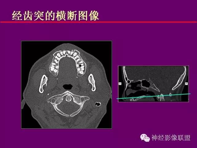 【PPT】颅底重要CT解剖及其临床意义