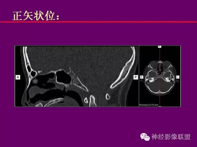 【PPT】颅底重要CT解剖及其临床意义