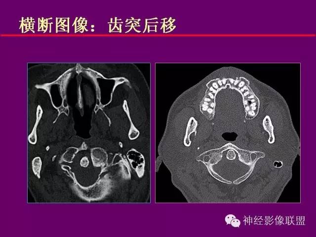 【PPT】颅底重要CT解剖及其临床意义