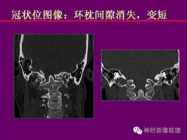【PPT】颅底重要CT解剖及其临床意义