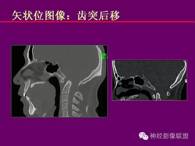 【PPT】颅底重要CT解剖及其临床意义
