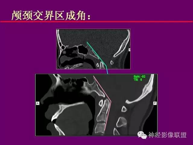 【PPT】颅底重要CT解剖及其临床意义