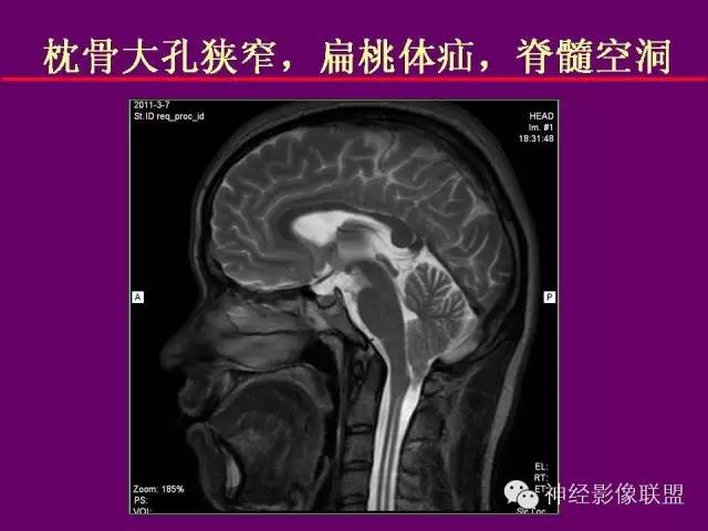 【PPT】颅底重要CT解剖及其临床意义