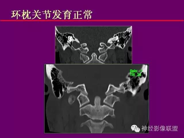 【PPT】颅底重要CT解剖及其临床意义